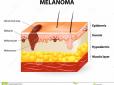 Вчені створили дієвий засіб для боротьби з меланомою