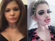 У мережі показали, який вигляд має дівчина з найбільшими губами в світі (фото)